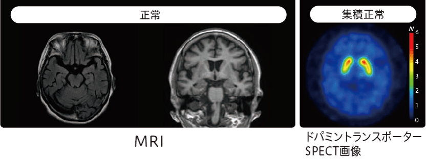 レビー小体型認知症の原因と画像所見レビー小体型認知症との鑑別が必要 